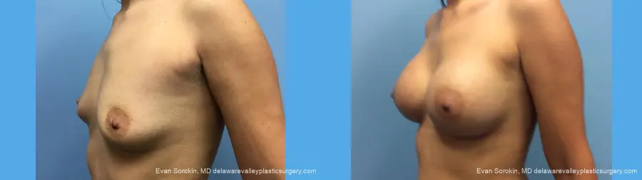 Breast Augmentation: Patient 137 - Before and After 2