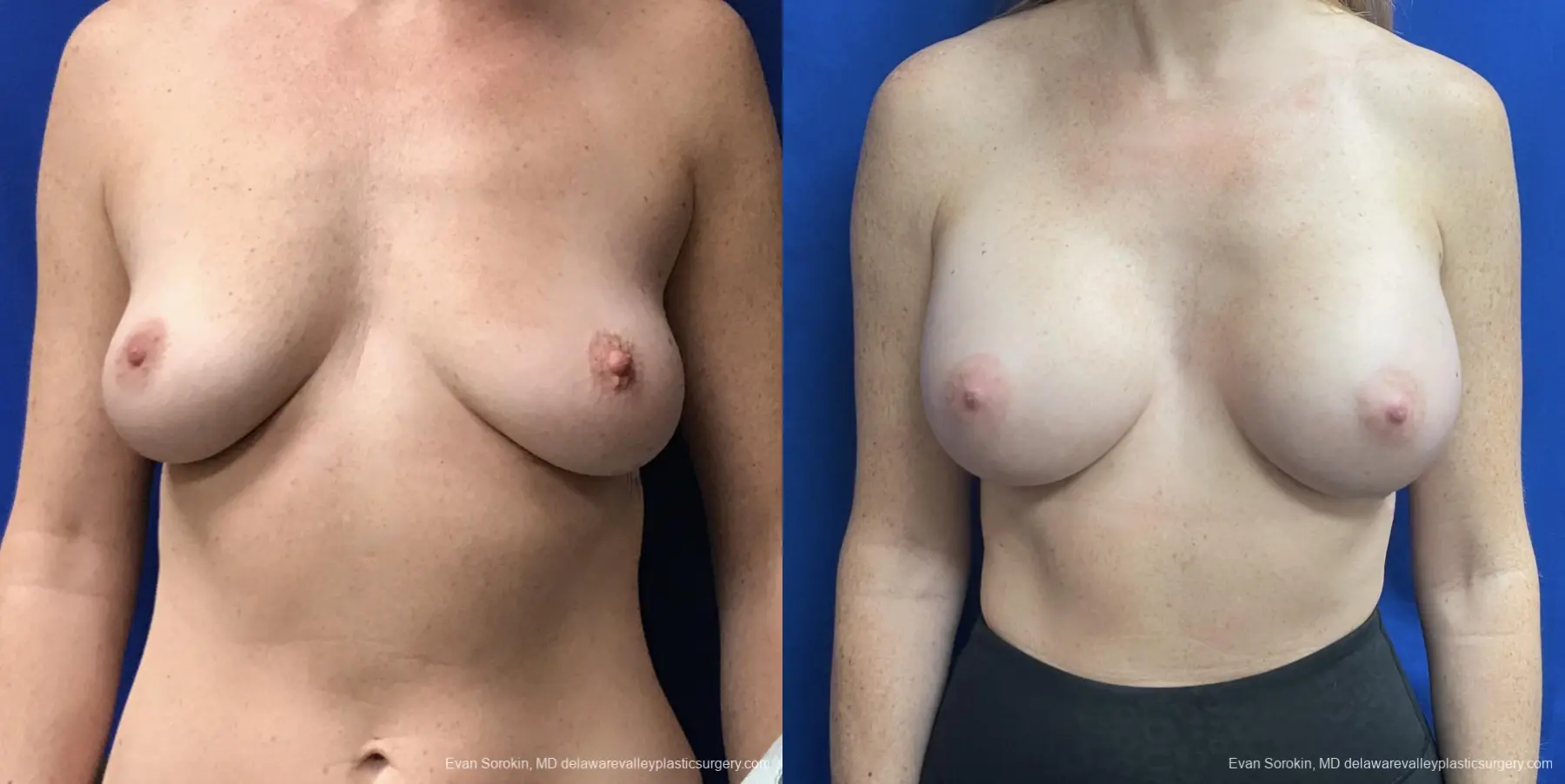 Breast Augmentation: Patient 235 - Before and After 1