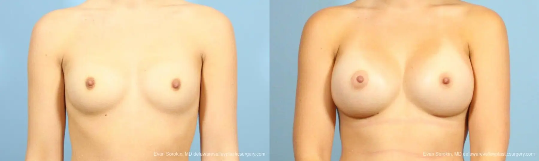 Philadelphia Breast Augmentation 8641 - Before and After