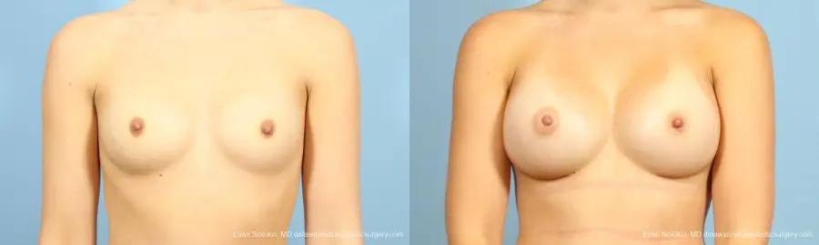 Philadelphia Breast Augmentation 8641 - Before and After 1