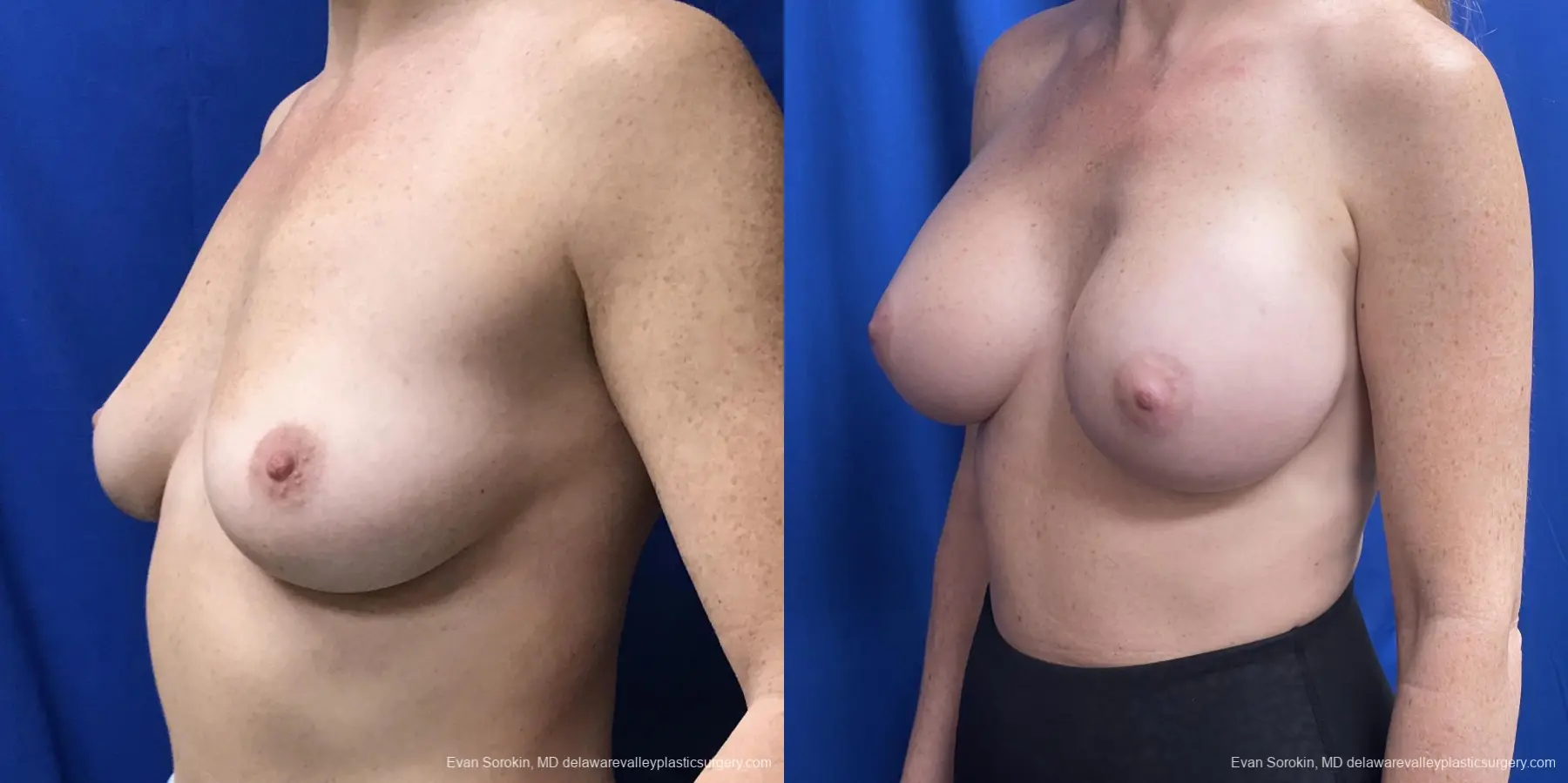Breast Augmentation: Patient 235 - Before and After 4