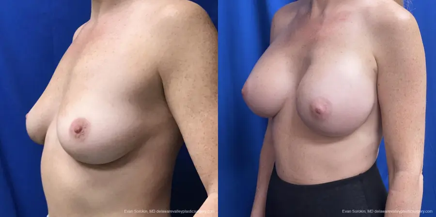 Breast Augmentation: Patient 231 - Before and After 4