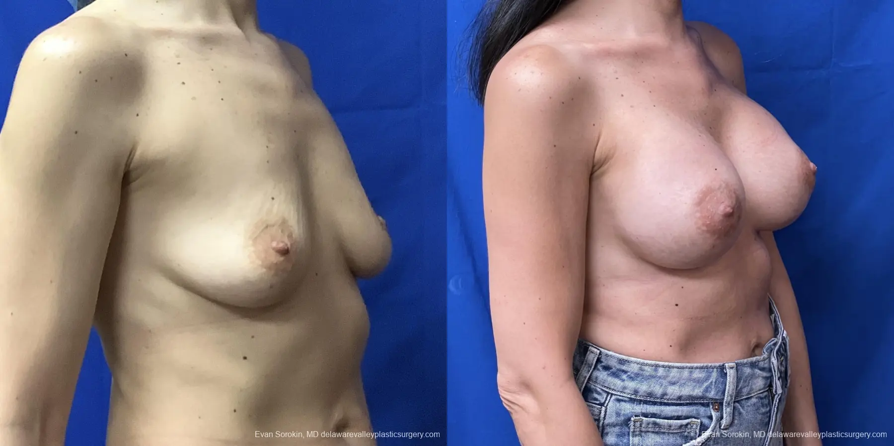 Breast Augmentation: Patient 173 - Before and After 2