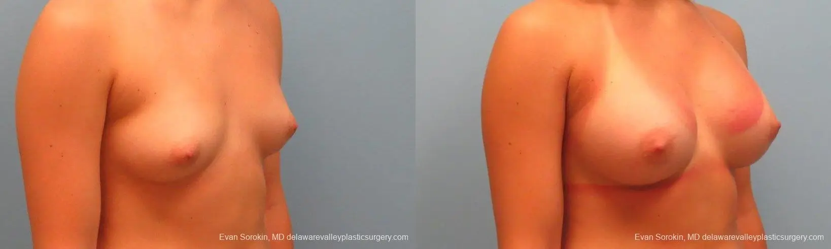 Philadelphia Breast Augmentation 9386 - Before and After 2