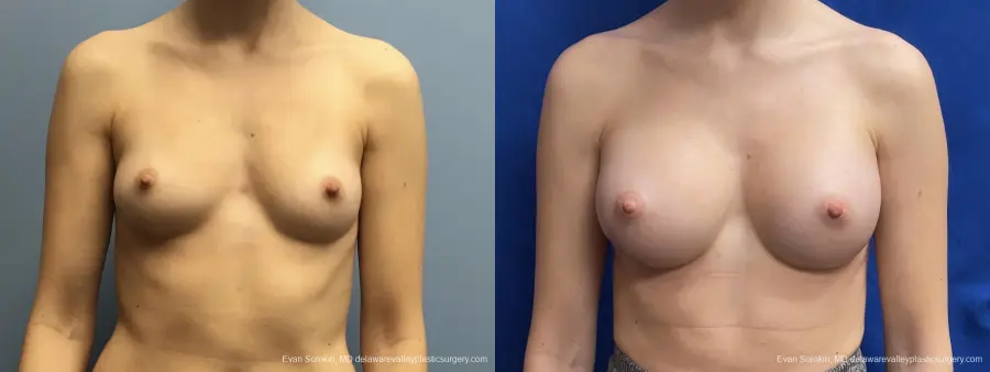 Breast Augmentation: Patient 201 - Before and After 1