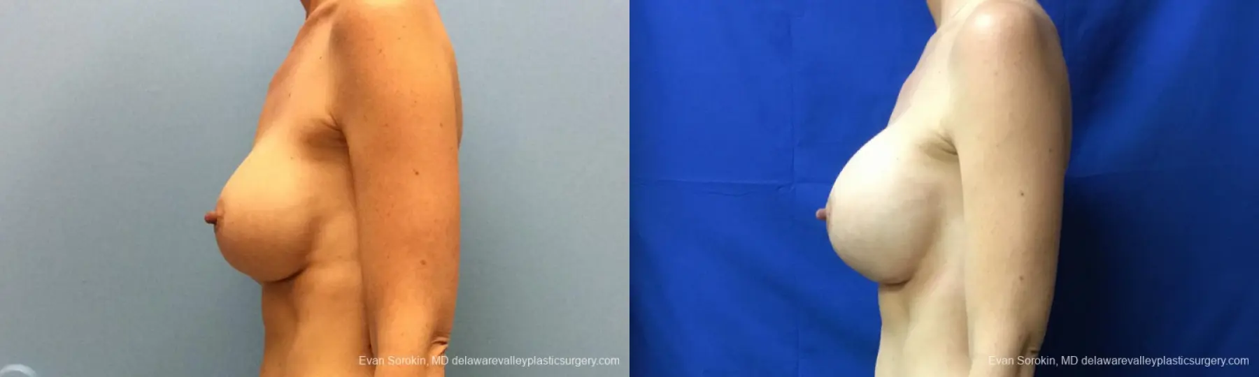 Philadelphia Breast Augmentation 10815 - Before and After 5
