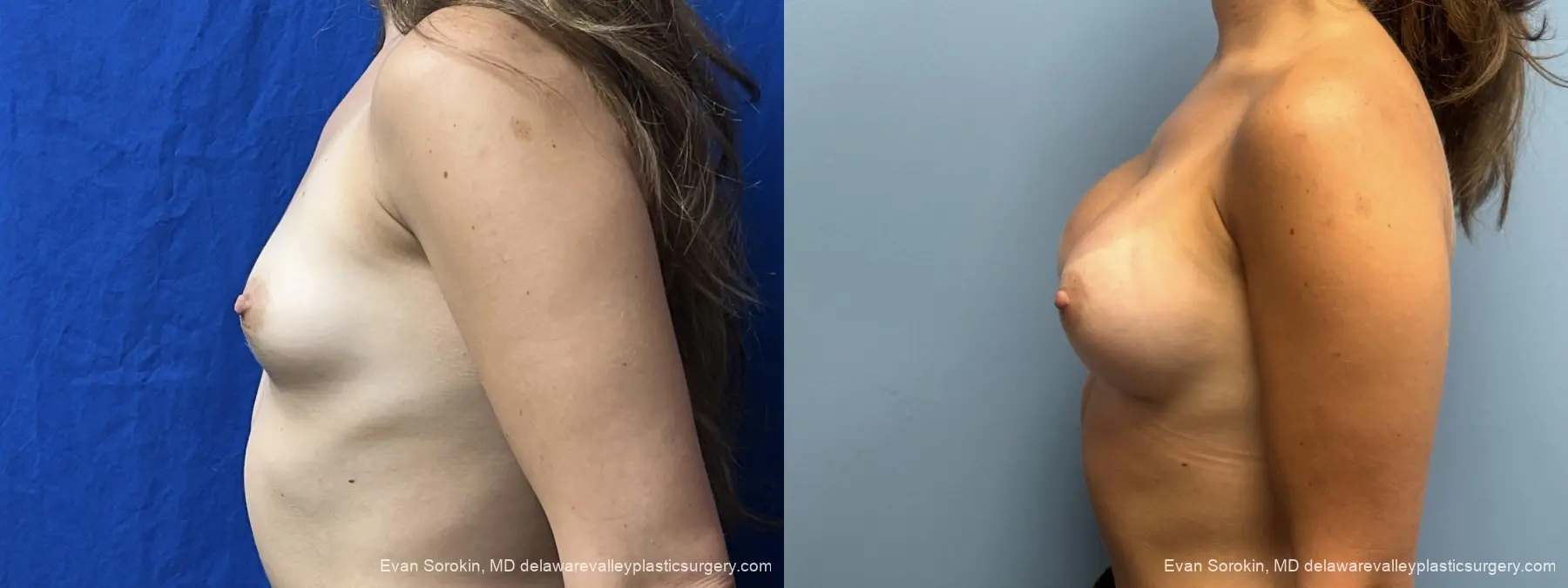 Breast Augmentation: Patient 3 - Before and After 5