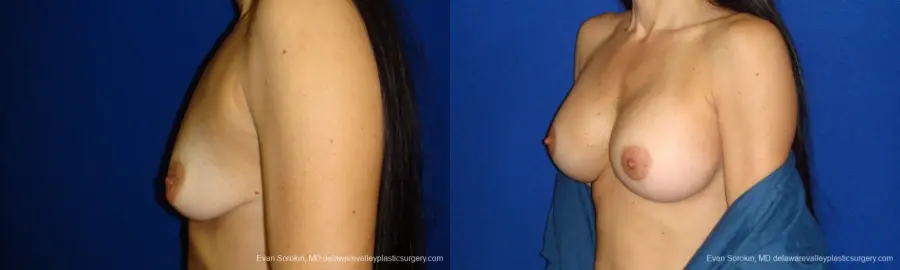 Philadelphia Breast Augmentation 9413 - Before and After 5