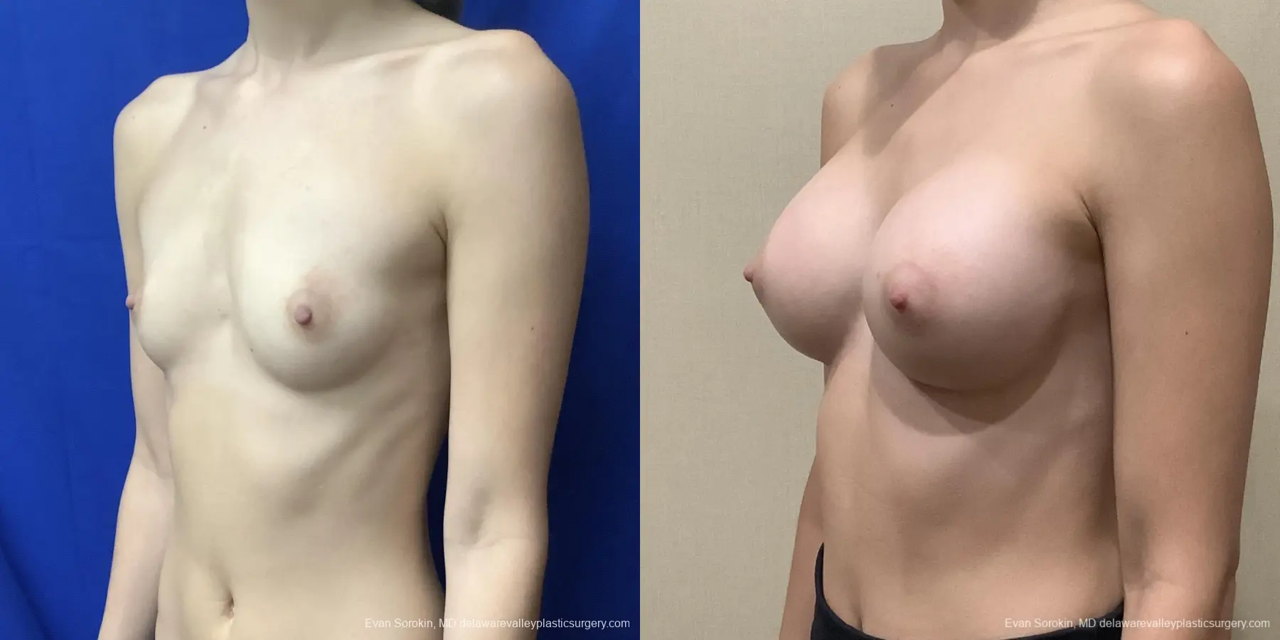 Breast Augmentation: Patient 181 - Before and After 4