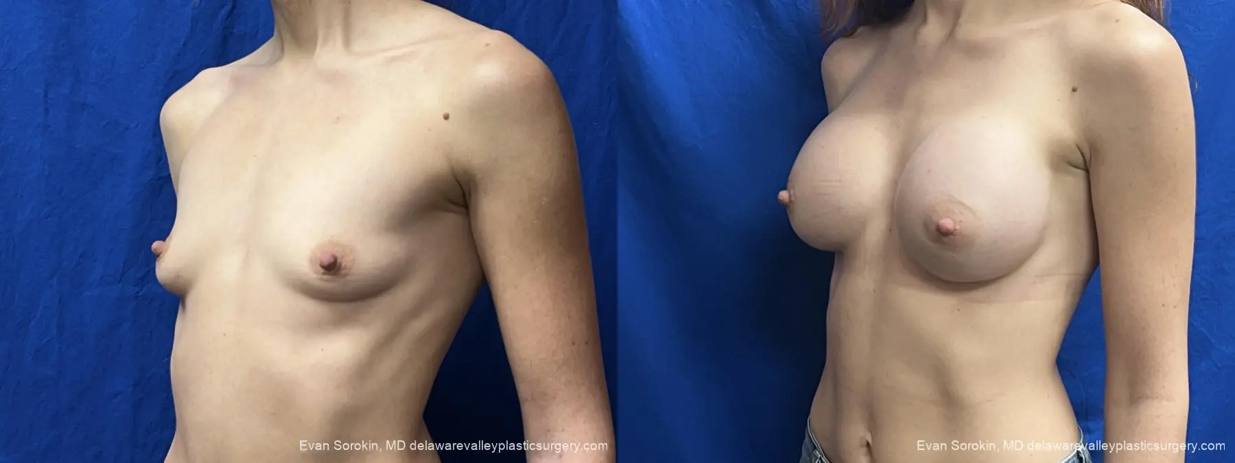 Breast Augmentation: Patient 307 - Before and After 4