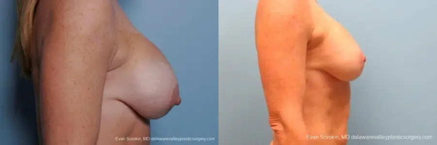 Philadelphia Breast Augmentation 8693 - Before and After 4