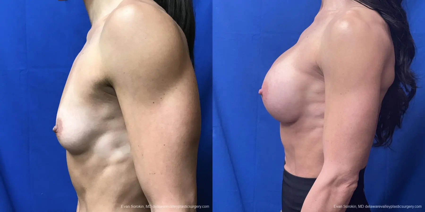 Breast Augmentation: Patient 218 - Before and After 3