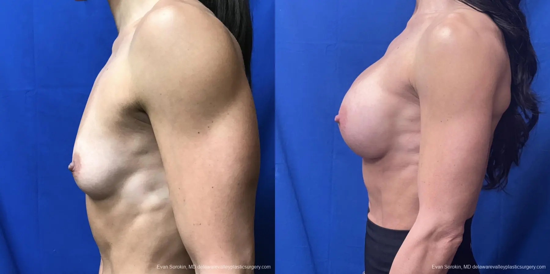 Breast Augmentation: Patient 189 - Before and After 3