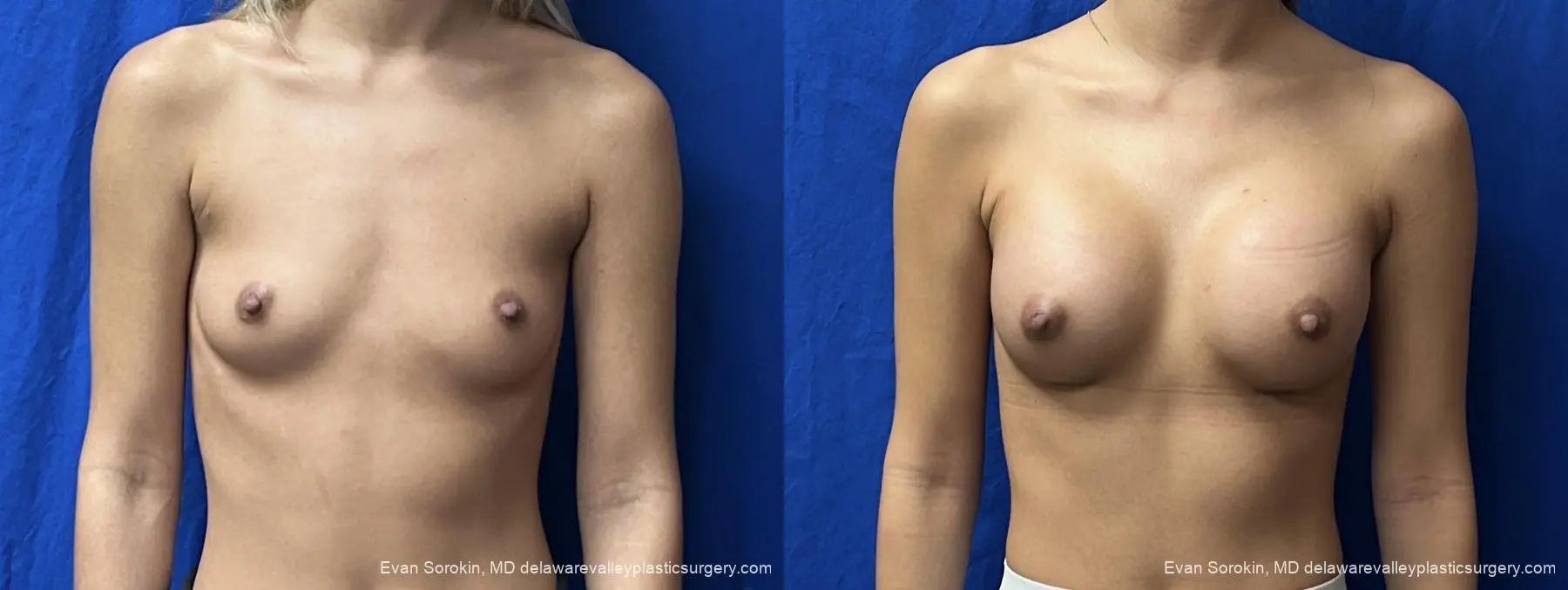 Breast Augmentation: Patient 327 - Before and After 1
