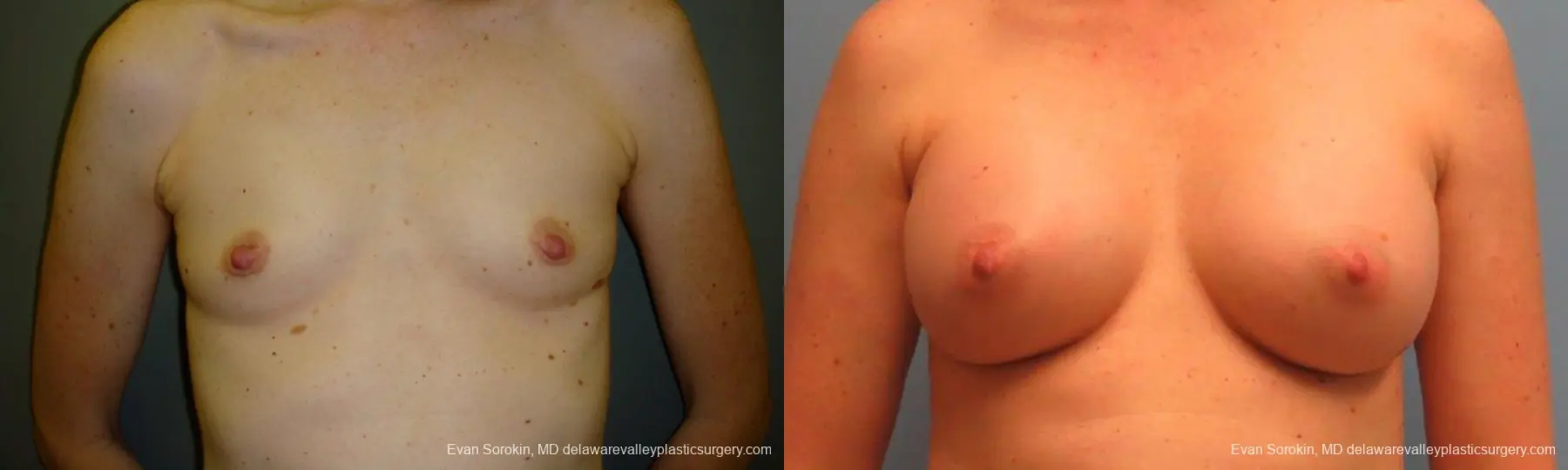 Philadelphia Breast Augmentation 9180 - Before and After 1