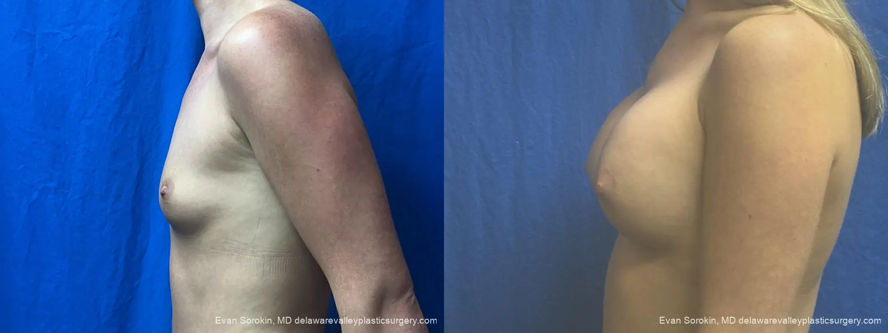 Breast Augmentation: Patient 328 - Before and After 5
