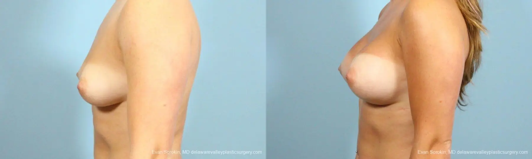 Philadelphia Breast Augmentation 8650 - Before and After 5