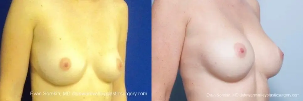 Philadelphia Breast Augmentation 8776 - Before and After 2