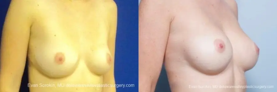 Philadelphia Breast Augmentation 8776 - Before and After 2