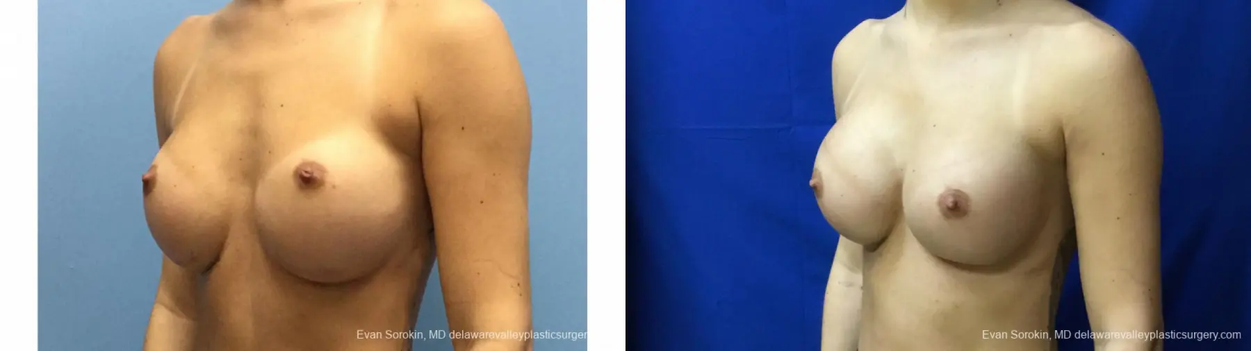 Philadelphia Breast Augmentation 13177 - Before and After 4