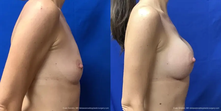 Breast Augmentation: Patient 222 - Before and After 3