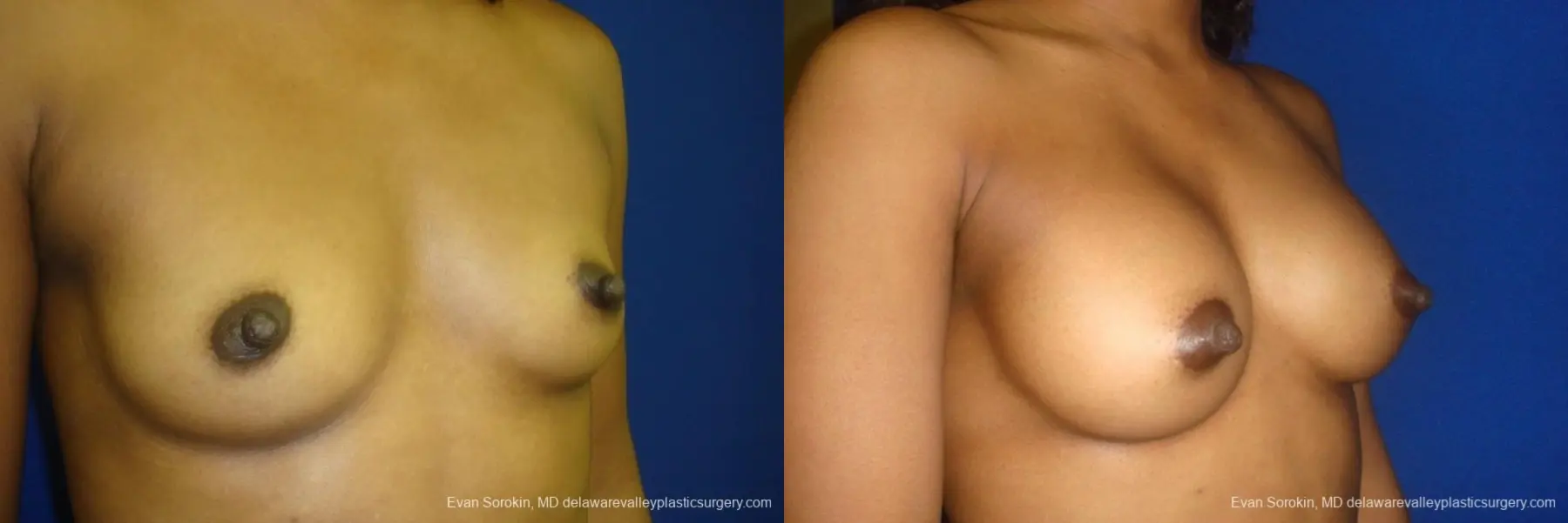 Philadelphia Breast Augmentation 8665 - Before and After 2