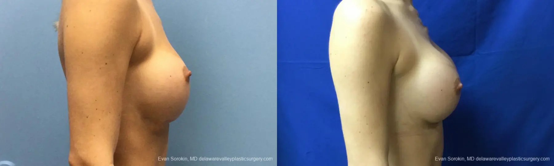 Philadelphia Breast Augmentation 10816 - Before and After 3