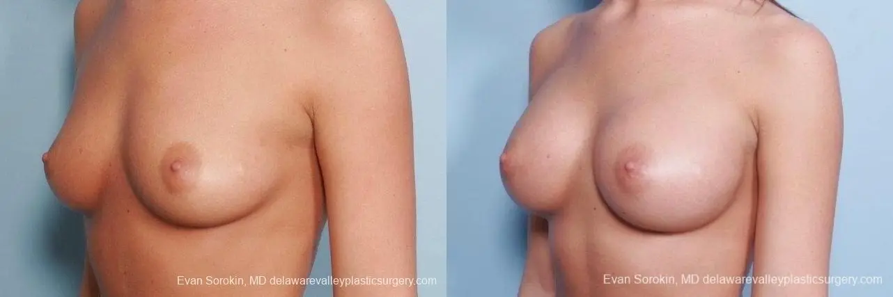 Philadelphia Breast Augmentation 8792 - Before and After 3