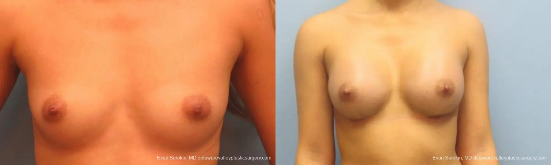 Philadelphia Breast Augmentation 9341 - Before and After 1