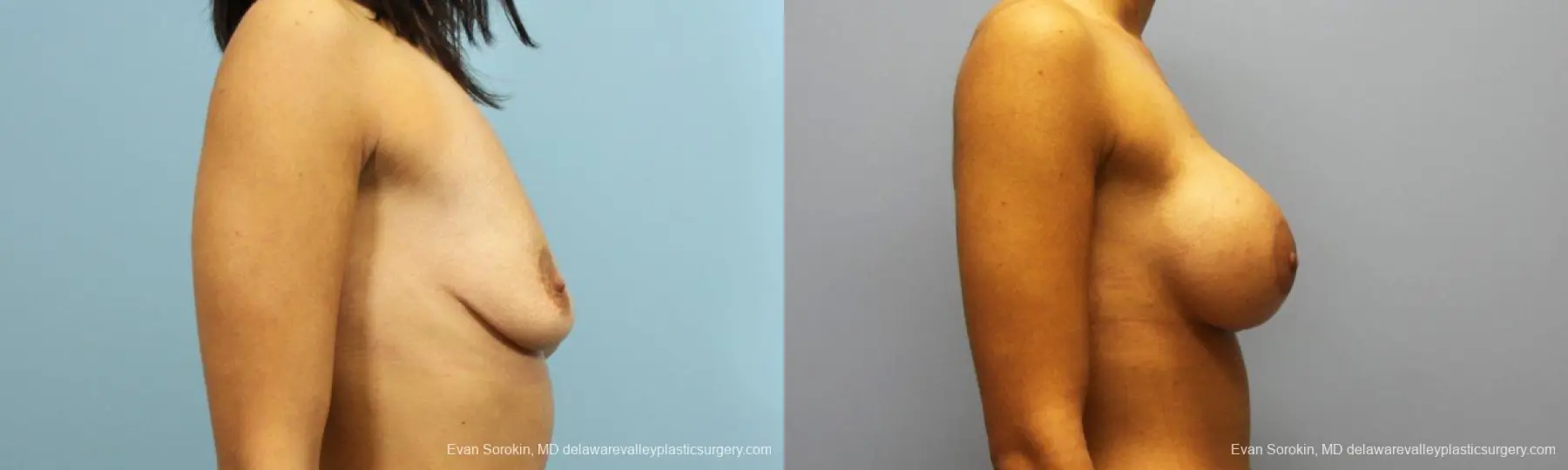 Philadelphia Breast Augmentation 9205 - Before and After 3