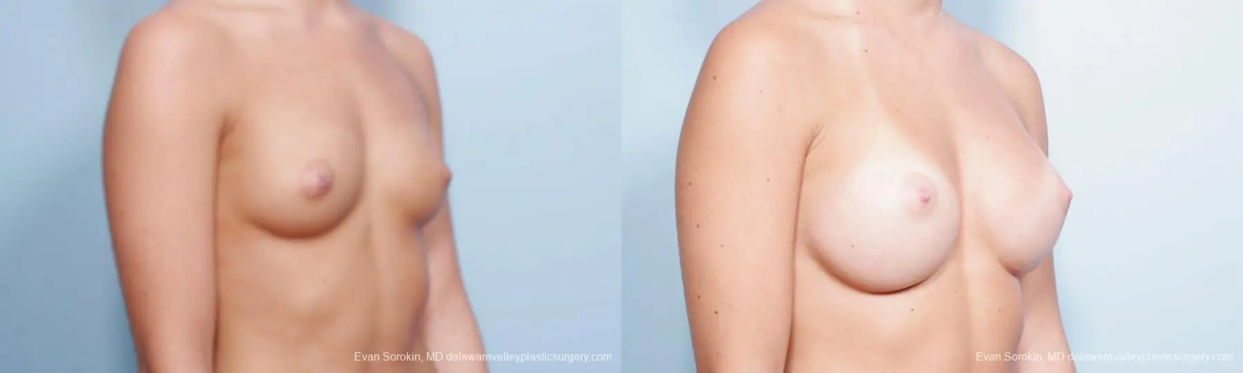 Philadelphia Breast Augmentation 9423 - Before and After 2