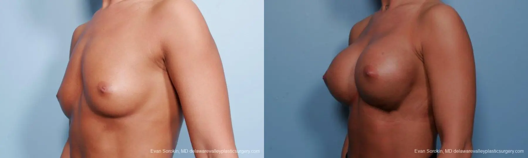 Philadelphia Breast Augmentation 9299 - Before and After 2