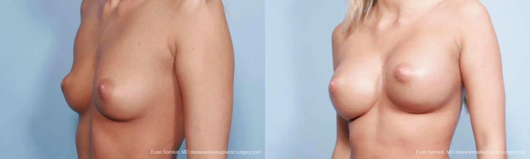 Philadelphia Breast Augmentation 9177 - Before and After 2