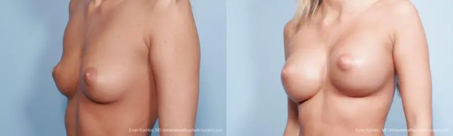 Philadelphia Breast Augmentation 9177 - Before and After 2
