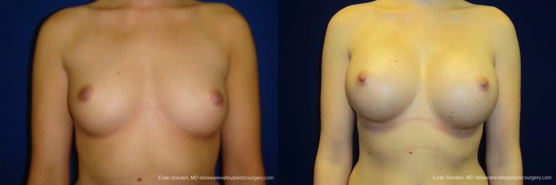 Philadelphia Breast Augmentation 8670 - Before and After 1