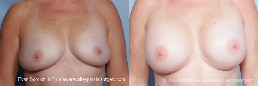 Philadelphia Breast Augmentation 9316 - Before and After 1