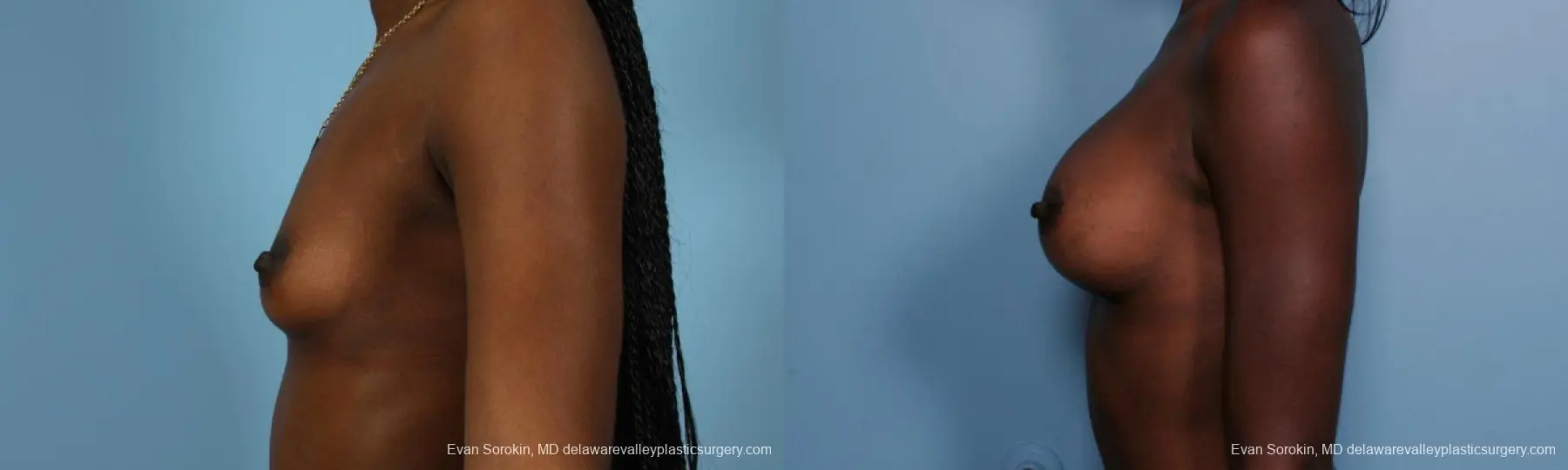 Philadelphia Breast Augmentation 8655 - Before and After 5