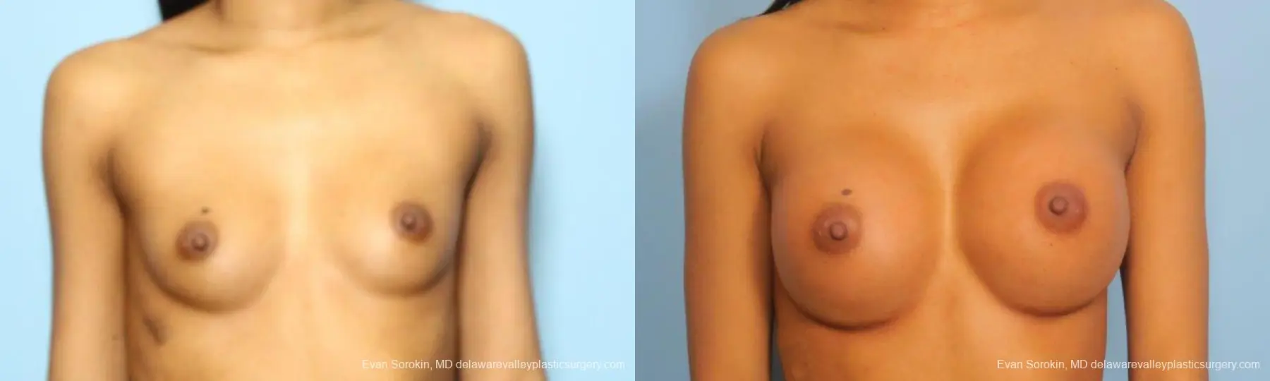 Philadelphia Breast Augmentation 9182 - Before and After 1