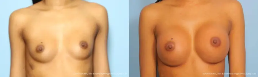 Philadelphia Breast Augmentation 9182 - Before and After 1
