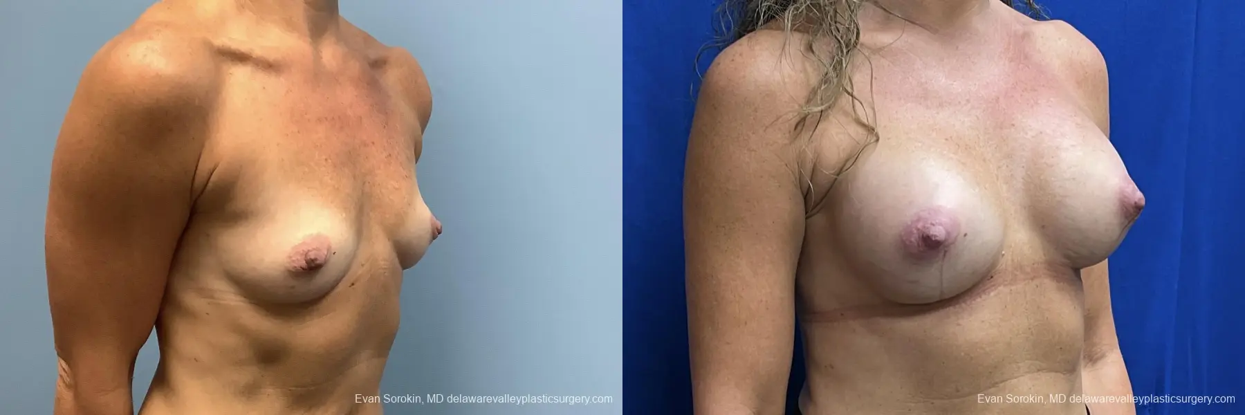 Breast Augmentation: Patient 204 - Before and After 2