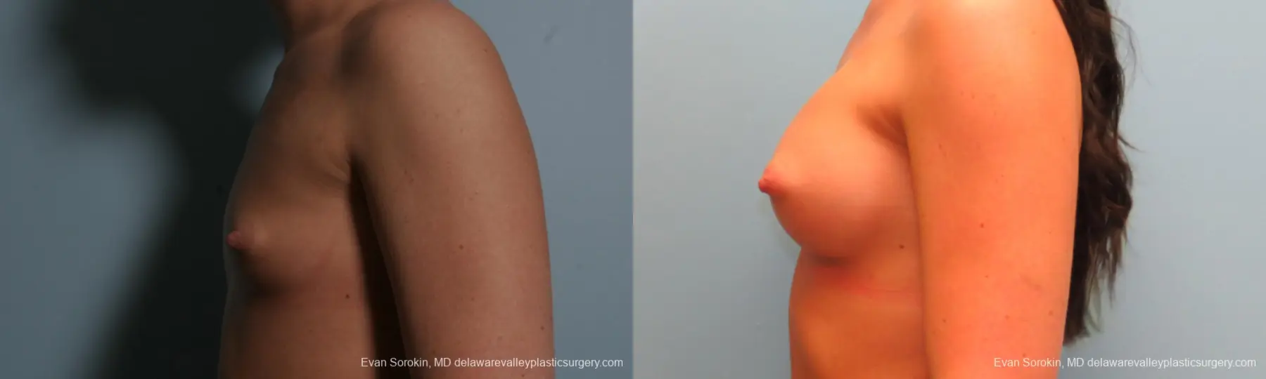Philadelphia Breast Augmentation 8664 - Before and After 5