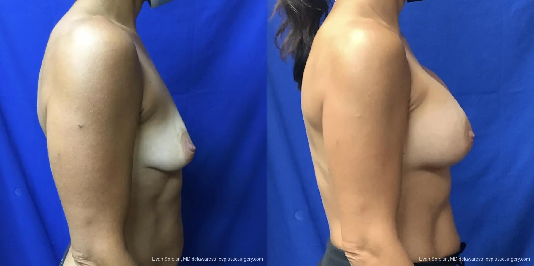 Breast Augmentation: Patient 187 - Before and After 3