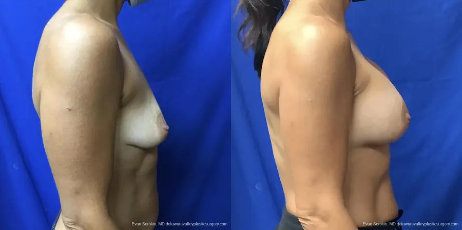 Breast Augmentation: Patient 187 - Before and After 3