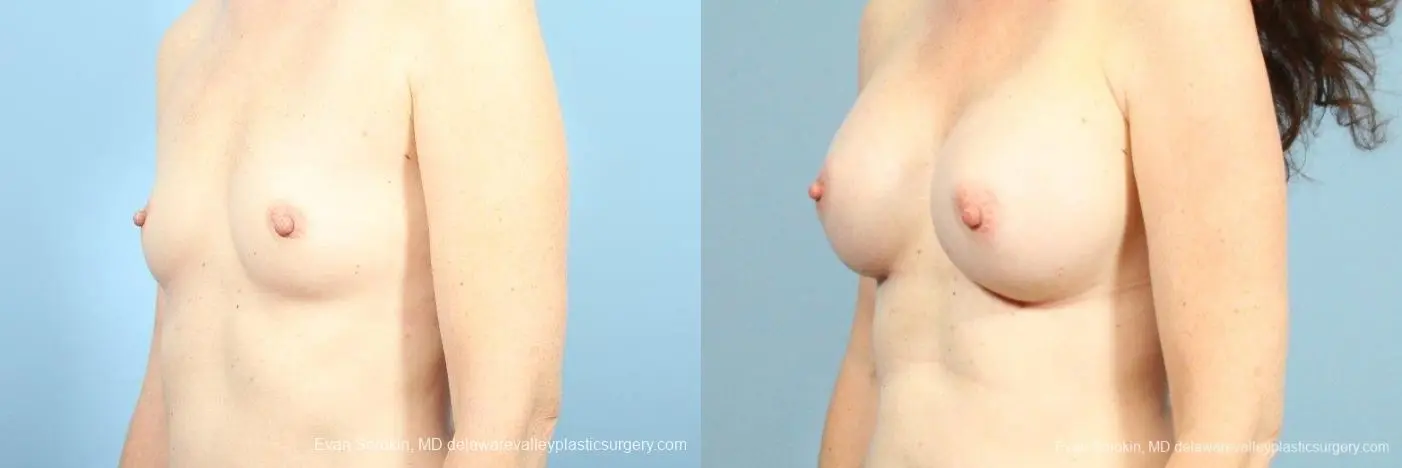 Philadelphia Breast Augmentation 8662 - Before and After 3
