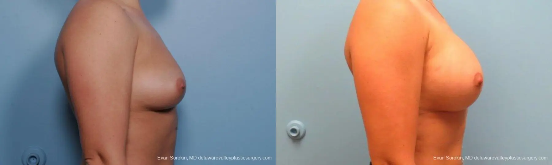Philadelphia Breast Augmentation 9383 - Before and After 3