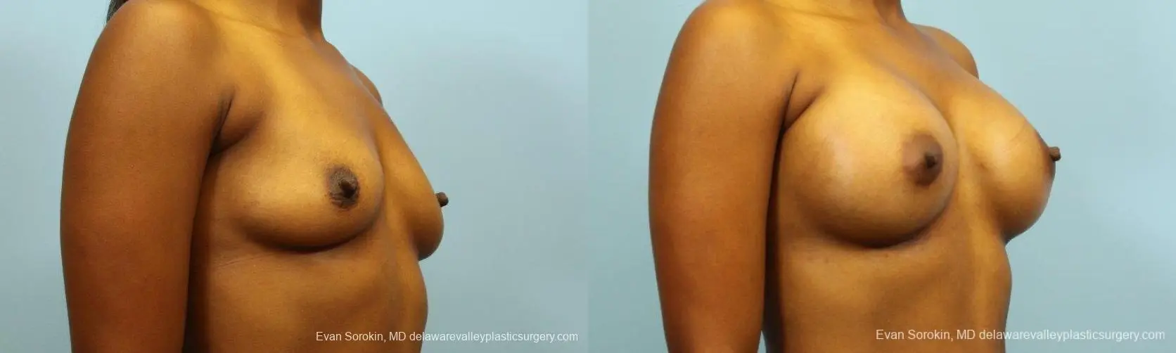 Philadelphia Breast Augmentation 8768 - Before and After 2