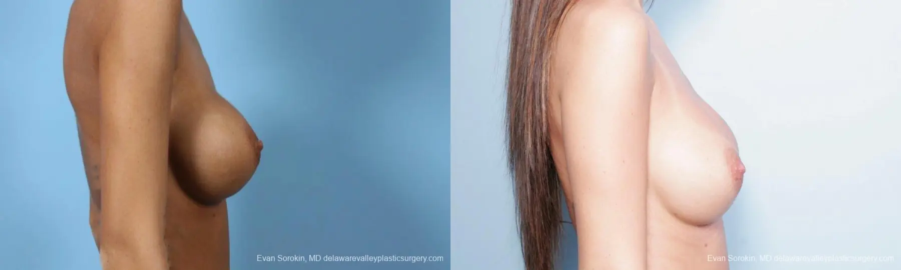 Philadelphia Breast Augmentation 9445 - Before and After 5