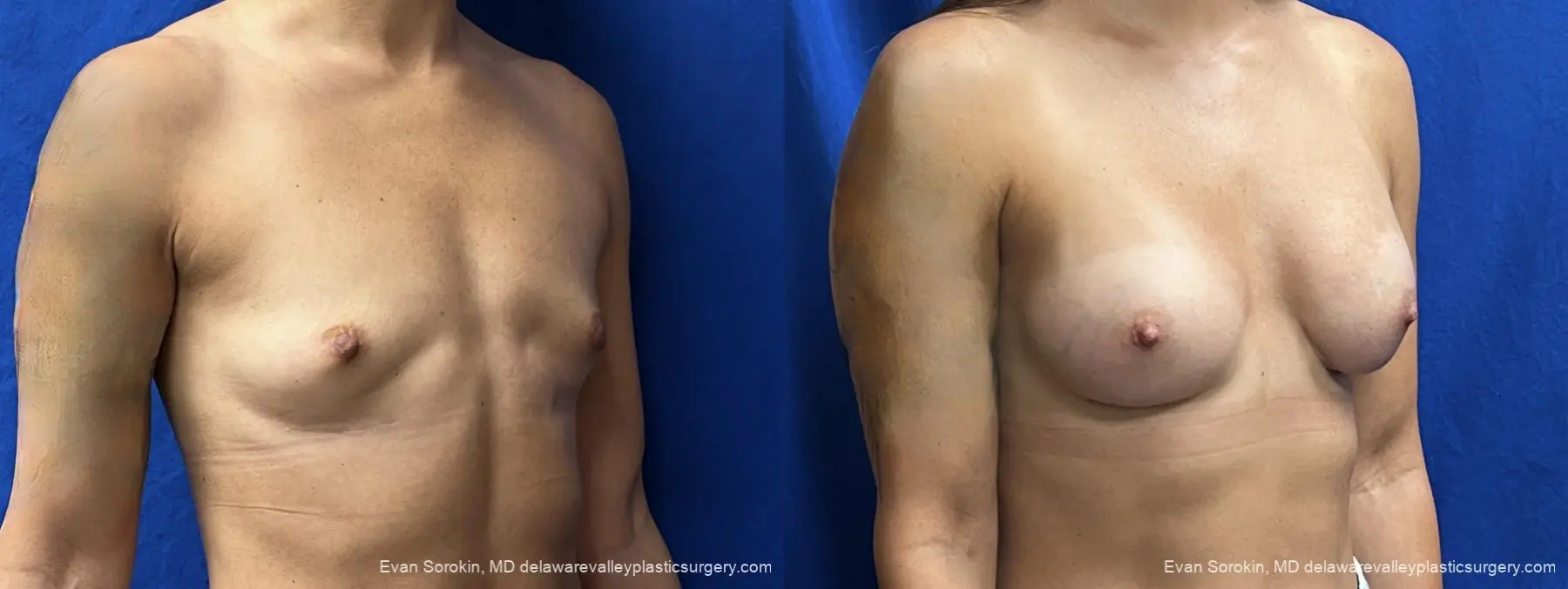 Breast Augmentation: Patient 309 - Before and After 2