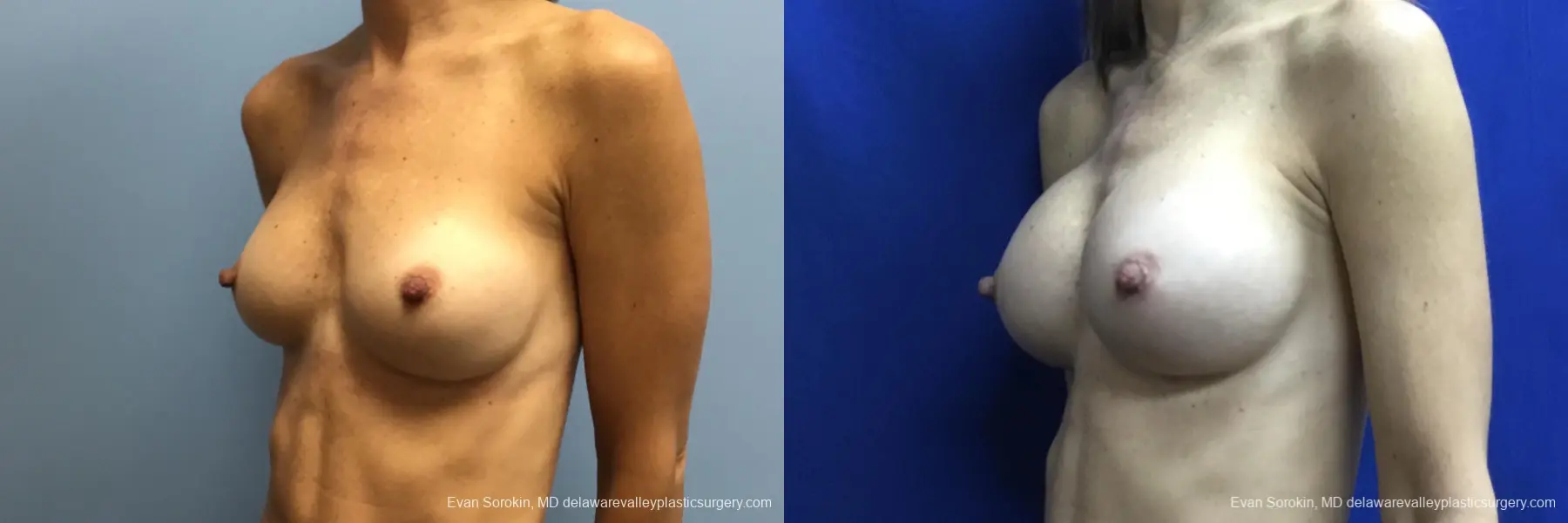Breast Augmentation: Patient 223 - Before and After 4