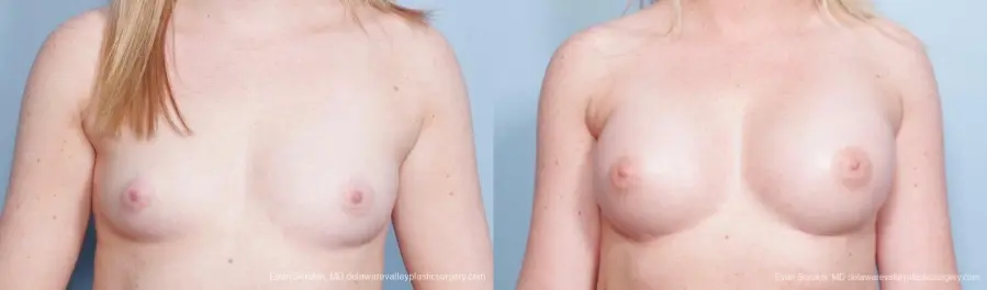 Philadelphia Breast Augmentation 8778 - Before and After 1